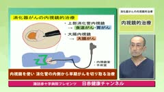 消化器がんの内視鏡的治療について